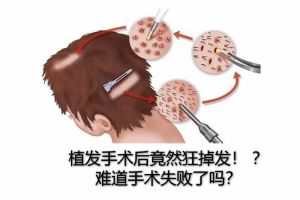 植髮手術後竟然狂掉髮！ ？難道手術失敗了嗎？
