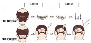 使用自體毛髮移植真的不需要術後護理嗎？