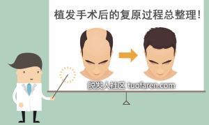 植髮手術後的復原過程總整理!