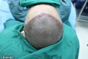 大麥微針植髮：植髮效果不理想，到底是哪些導致的？