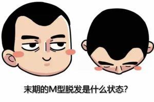 末期的Ｍ型脱髮是什麼狀態？ 【避免情況已無法挽救的方法】