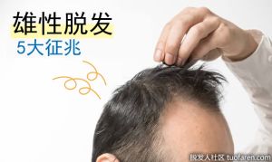 AGA雄性脱髮有前兆?雄性脱髮的5大徵兆