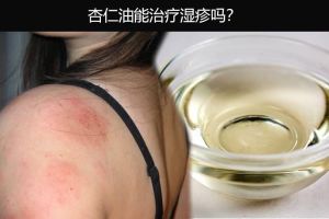 杏仁油能治療濕疹嗎？