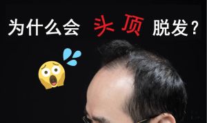 為什麼頭頂稀疏脱髮？脱髮原因出在雄激素! ?