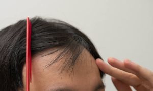 如何知道自己有沒有脱髮?用這幾種方法分辨M型脱髮!