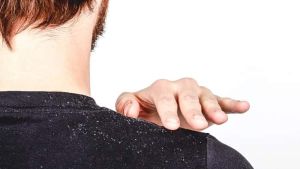 產生頭皮屑的原因 去除頭皮屑的方法(去除頭皮角質)