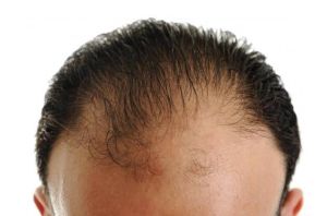 如何自然治療脱髮