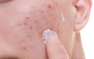 毛囊炎的5種自制療法