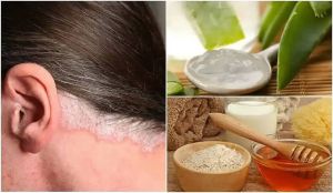 頭皮牛皮癬的5種有效家庭療法