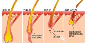 如果很多正常的頭髮突然脱落怎麼辦？懷疑休止期脱髮