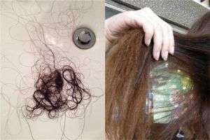 2個症狀可以確認是否存在脱髮