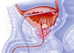 5種食物讓你的前列腺保持健康
