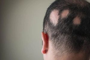 不考慮遺傳而發生的脱髮——圓形脱髮