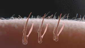 藥物脱髮治療的類型 - 血管擴張劑(米諾地爾)