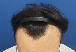 脱髮自我診斷方法