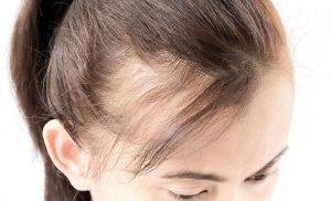 女性脱髮更難治療... 推薦5個預防習慣
