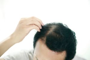 脱髮藥，用得越多越有效？ '錯'