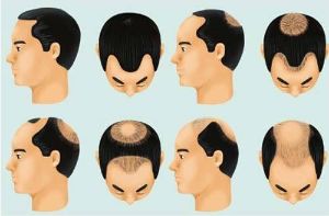 為什麼會發生脱髮？