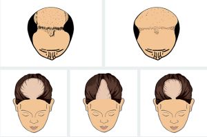 男性型脱髮的原因、症狀、治療、預防方法