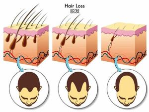 男性脱髮最有效的治療方法是什麼？