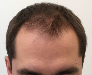 男性型脱髮的早期症狀及治療