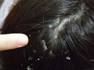 頭皮屑多的人被告知要小心脱髮...為什麼？