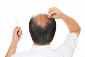 雄激素性脱髮的原因和治療方法