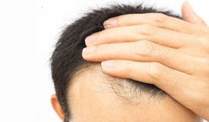 男性20歲禿頂有哪些表現？