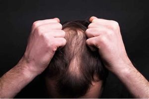 為什麼頭髮會脱落？脱髮的8個原因