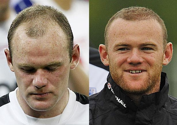 Hair-transplant-Wayne-Rooney.jpg