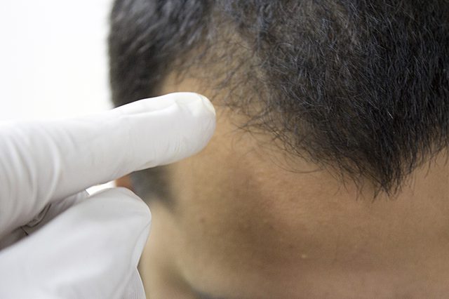 頭髮移植 頭髮移植