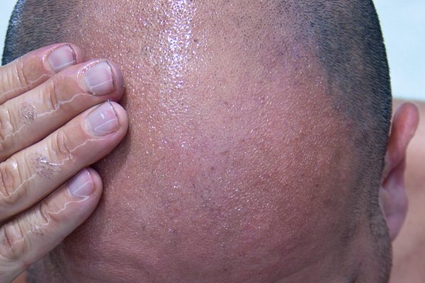 增加頭皮的血液循環4 增加頭皮的血液循環4