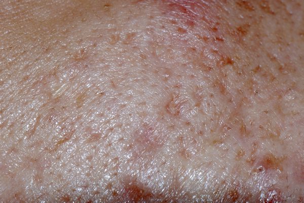 頭皮腫塊的成因