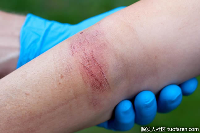 覆盆子籽油具有有效的抗病毒和抗菌性能 覆盆子籽油具有有效的抗病毒和抗菌性能