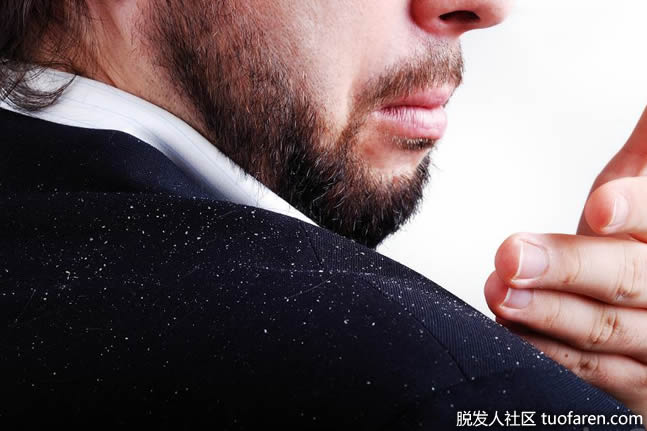 迷迭香髮油可能對治療頭皮屑有幫助 迷迭香髮油可能對治療頭皮屑有幫助