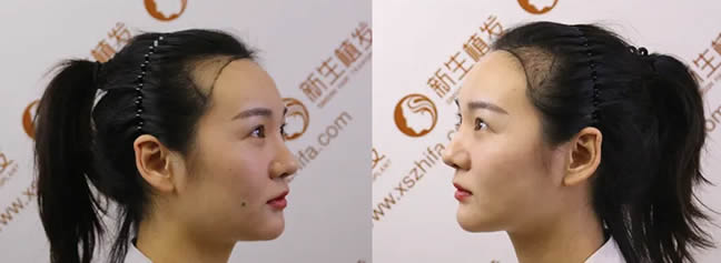 新生植髮李女士植髮案例 新生植髮李女士植髮案例