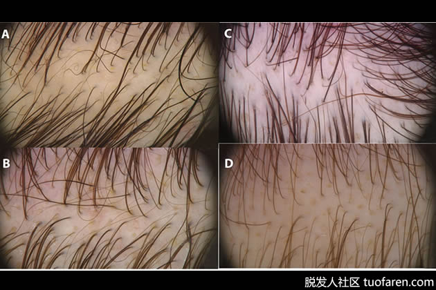 瀰漫性脱髮如何診斷 瀰漫性脱髮如何診斷