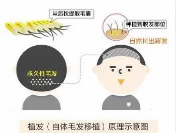 植髮手術的原理