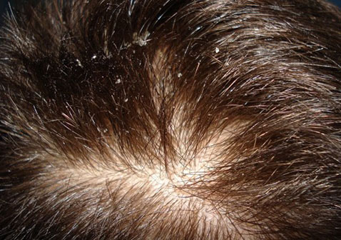 頭部脂溢性皮炎圖片2