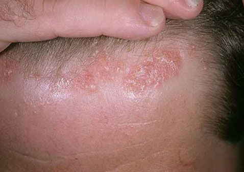 頭部脂溢性皮炎圖片4