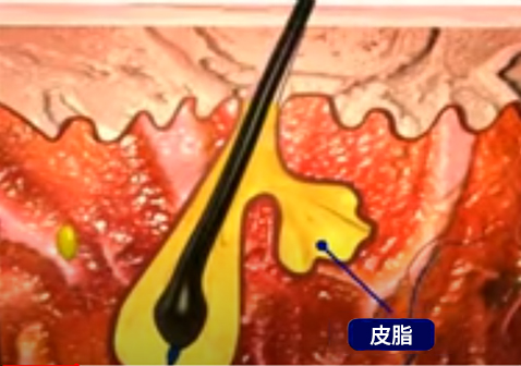 頭上長疙瘩形成過程2皮脂腺產生過多的皮脂圖片