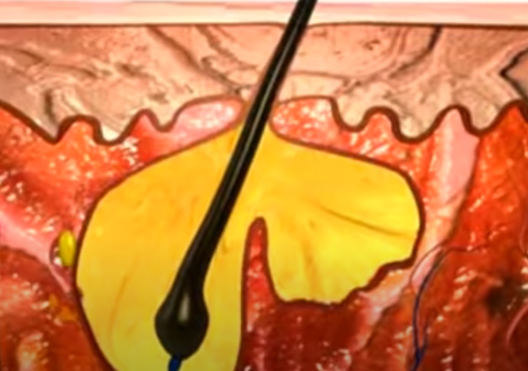 頭上長疙瘩形成過程3皮脂進一步擴展圖片