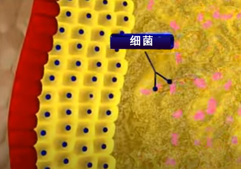 頭上長疙瘩形成過程4細菌感染圖片