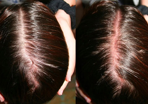 頭髮掉的厲害早期症狀圖片曬傷變薄