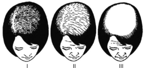 <a href='t/t_393' title='女性脱髮' target='_blank'>女性脱髮</a>類型圖 女性<a href='t/t_307' title='脱髮類型' target='_blank'>脱髮類型</a>圖