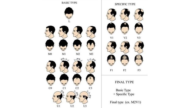 BASP分類系統使用了四種基本脱髮類型 BASP分類系統使用了四種基本脱髮類型