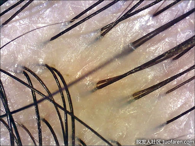 正常頭皮無皮屑、無發紅 正常頭皮無皮屑、無發紅