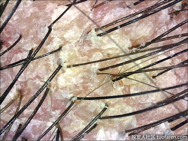 患者頭皮皮屑增加且皮膚髮紅。 患者頭皮皮屑增加且皮膚髮紅。