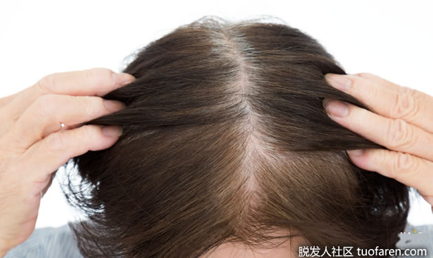 更年期和脱髮的關係