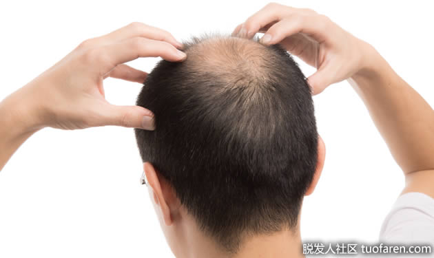 頭頂的雄性激素較多 頭頂的雄性激素較多